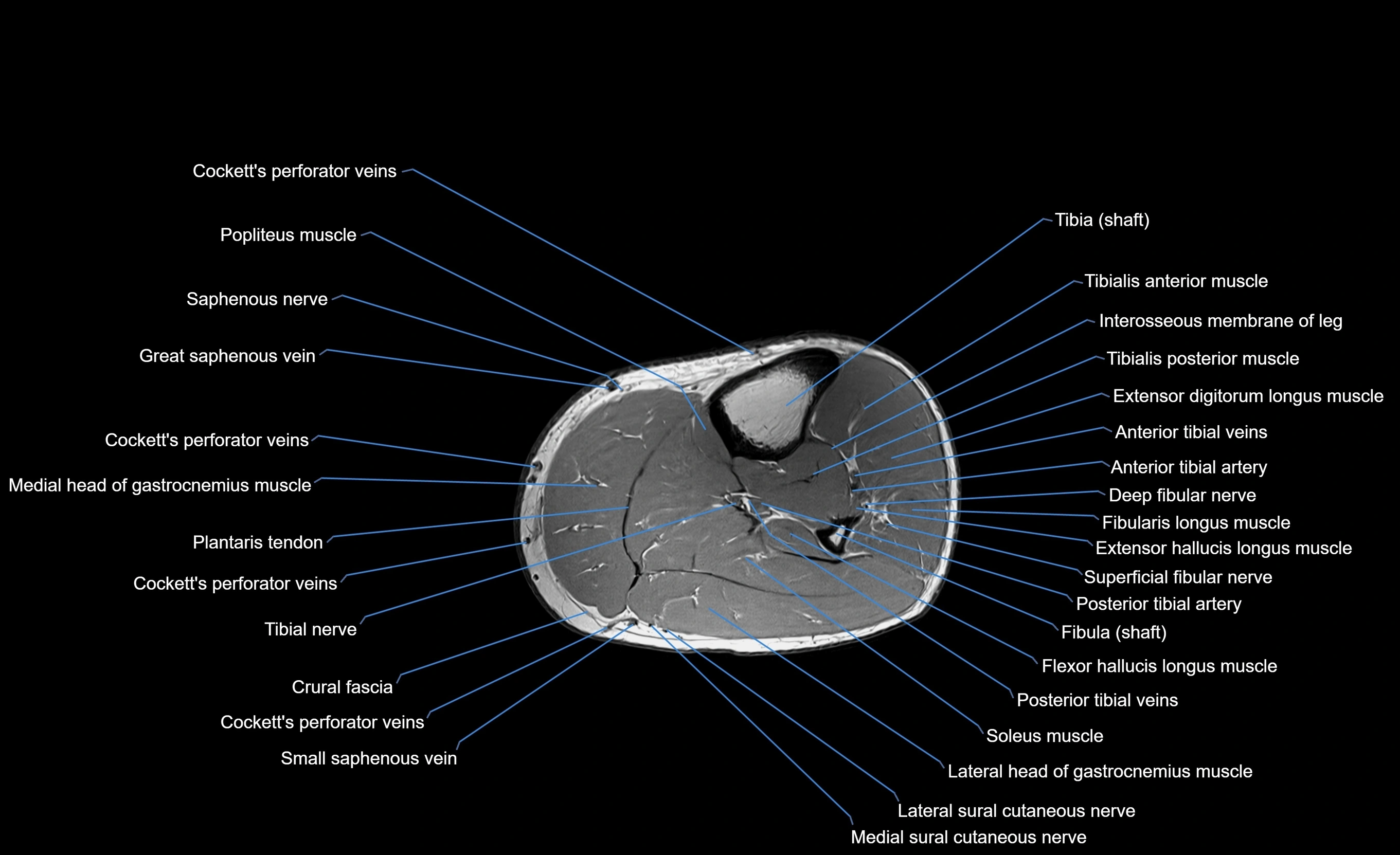 MRI lower leg axial cross sectional anatomy 3T  radiology  image-img-00001-00033.webp
